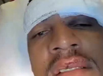 '[뉴스]'오버헤드킥에 얼굴 차여 실신' 수술대 올라 입술 30바늘 꿰맸다‥ 뉴스기사 썸네일